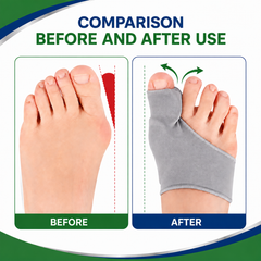 Hyggear™ Bunion Corrector - 946783246556